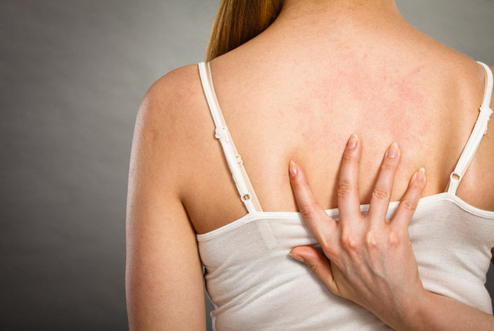 Eczema