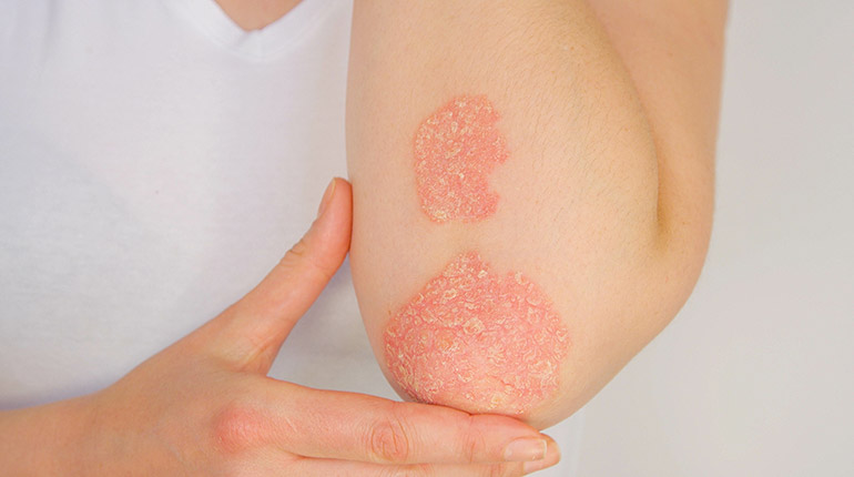 Psoriatic Arthritis