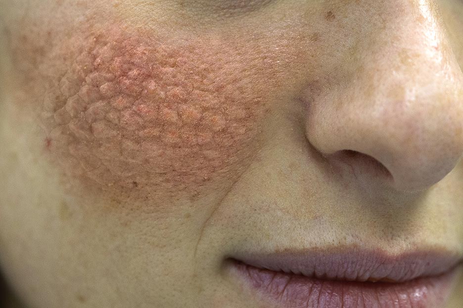 Lupus